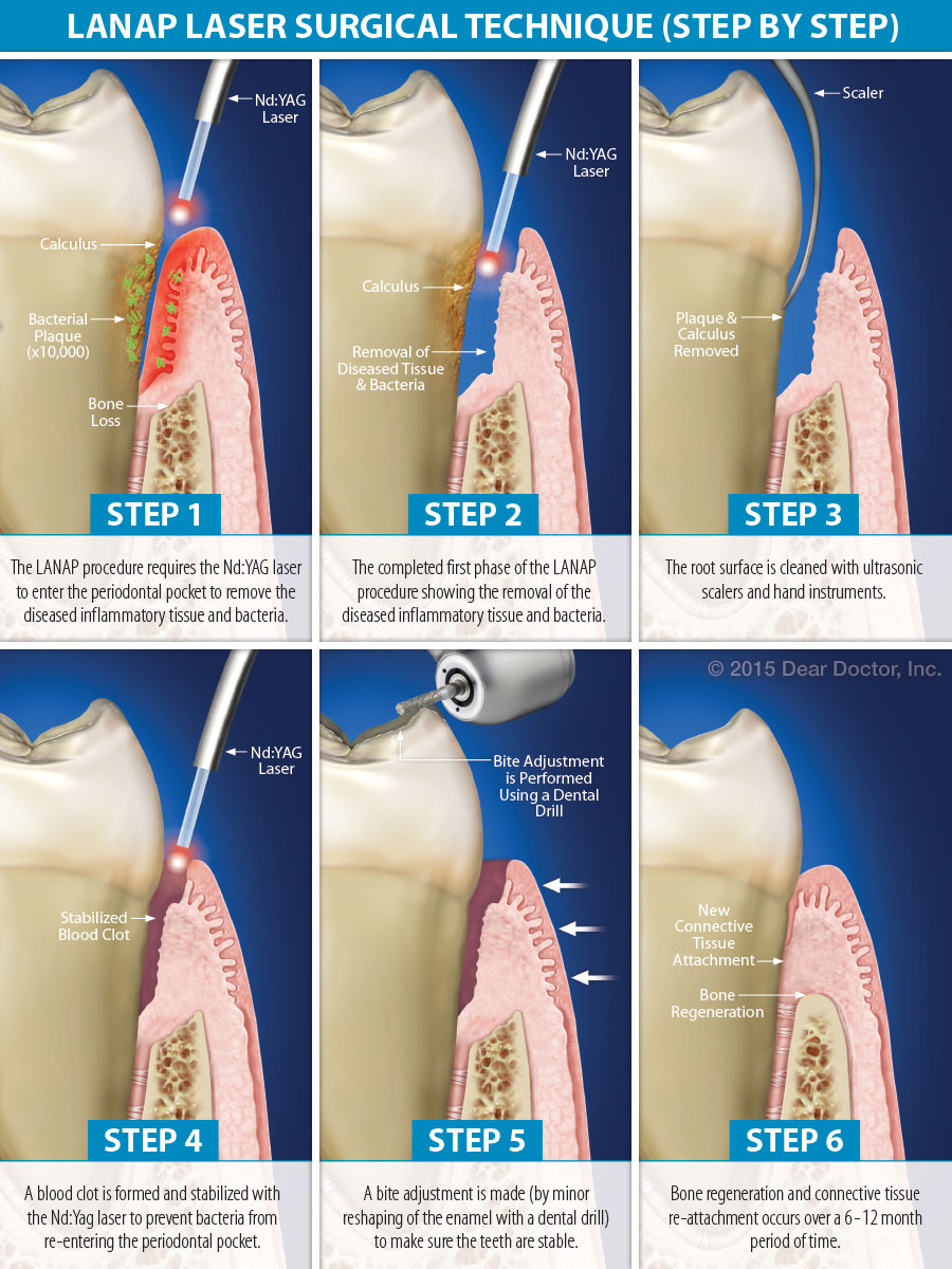 Periodontics Gum Surgery North County Dental Specialties